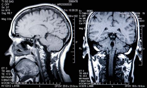 the villages brain scan mri